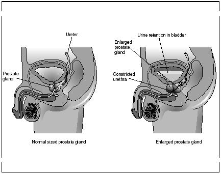 An enlarged prostate gland is a non-cancerous condition in which the narrowing of the urethra makes the elimination of urine more difficult. (Illustration by Electronic Illustrators Group.)